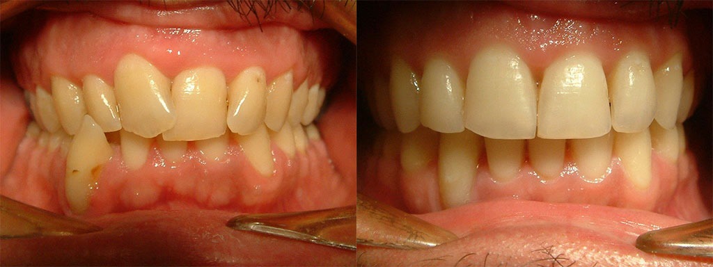 Συνωστισμός προσθίων άνω & κάτω δοντιών χωρίς εξαγωγές