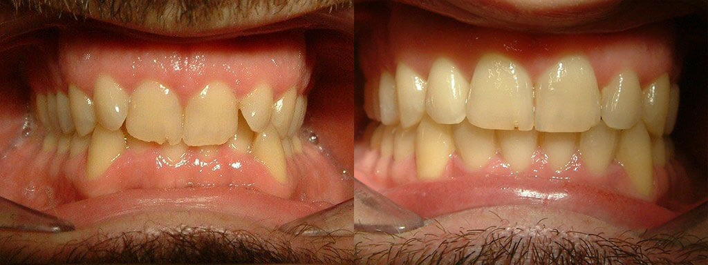 Διόρθωση βαθιάς σύγκλεισης & ευθυγράμμιση των δοντιών