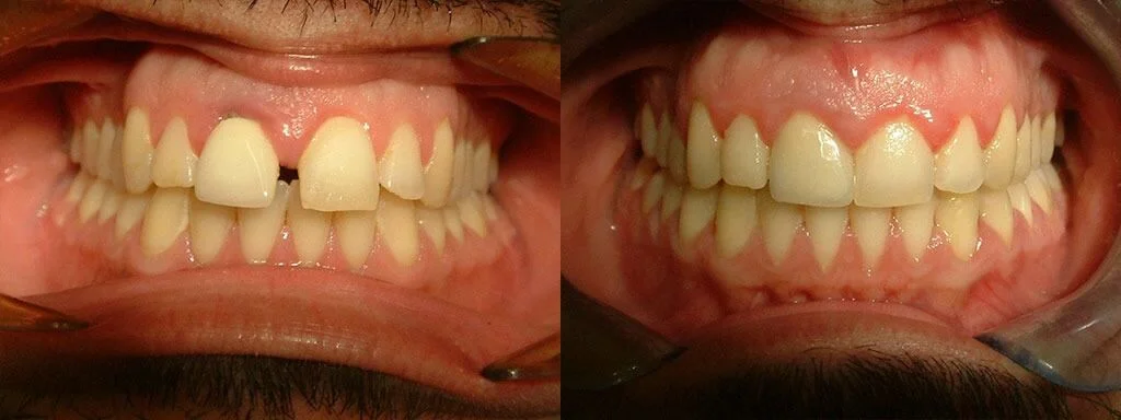 Αραιοδοντία δοντιών πριν & μετά