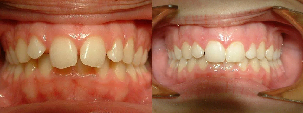 Αραιοδοντία δοντιών πριν & μετά