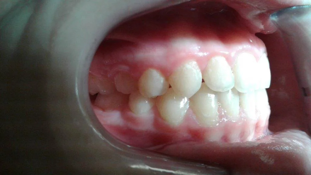 Συνωστισμός δοντιών μετά τη θεραπεία