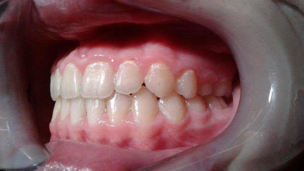 Συνωστισμός δοντιών μετά τη θεραπεία