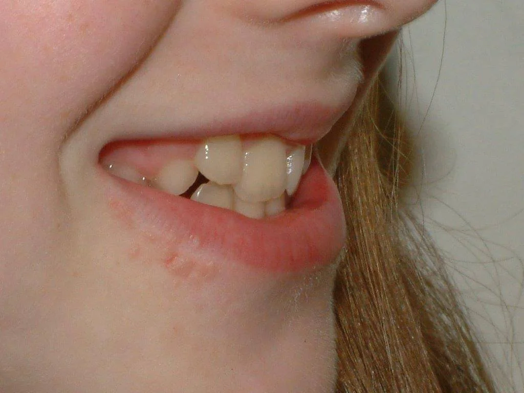 Συνωστισμός δοντιών πριν τη θεραπεία