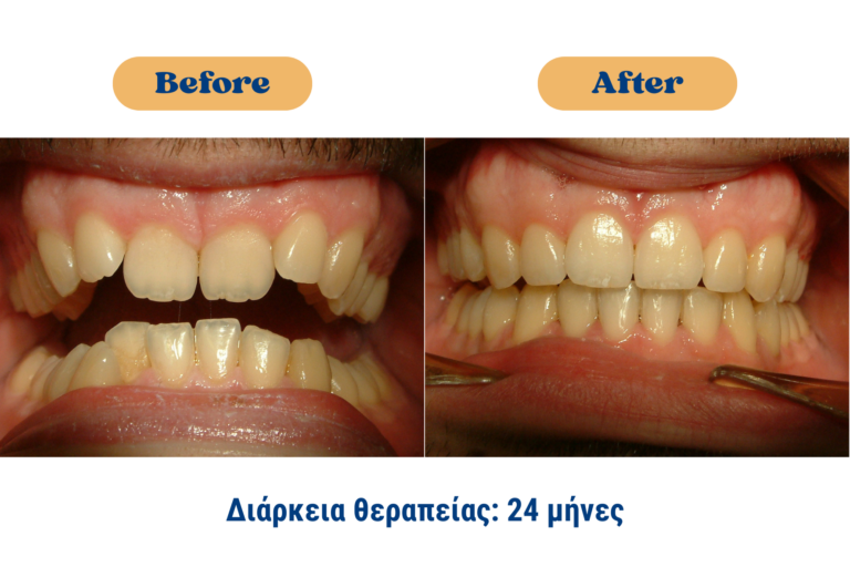 Case Study : Ορθοδοντική αντιμετώπιση ασθενούς με τάξη ΙΙ και συνωστισμό