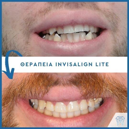 Invisalign-Lite